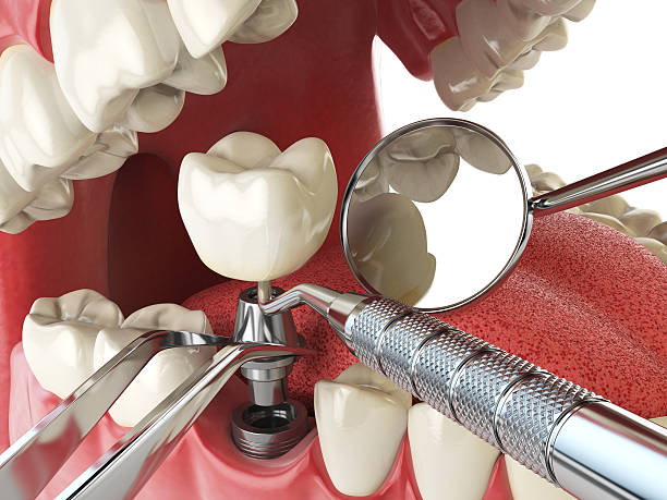 Best Emergency Dentist for Lost Fillings or Crowns in Winchester, TN